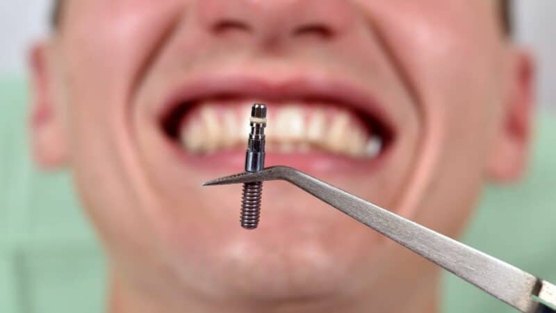 תהליך השתלת שיניים